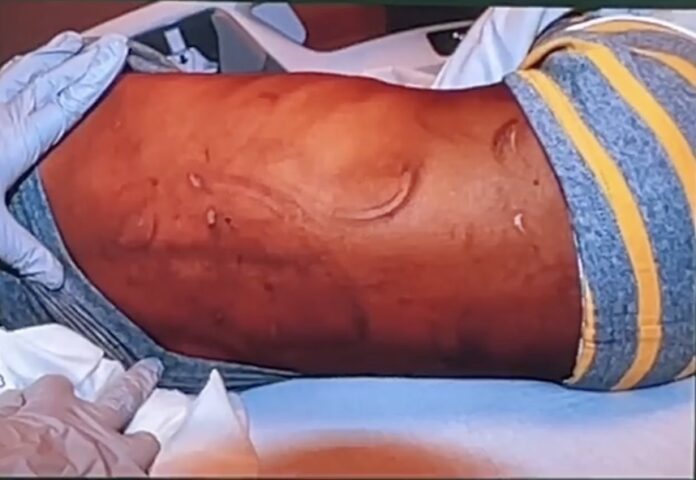 Scars and lacerations on 4 year old abused by Larry Rhodes and Bianca Blaise
